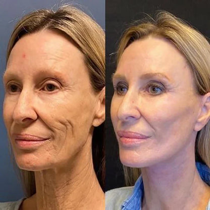 Orovita Botox Solution™