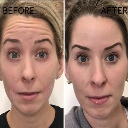 Orovita Botox Solution™